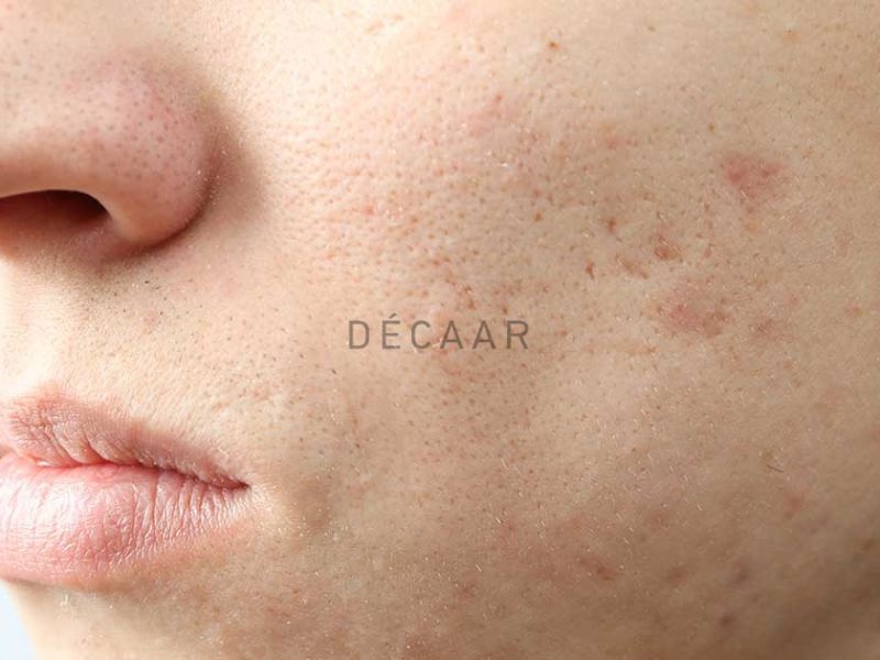 peel da trị sẹo rỗ